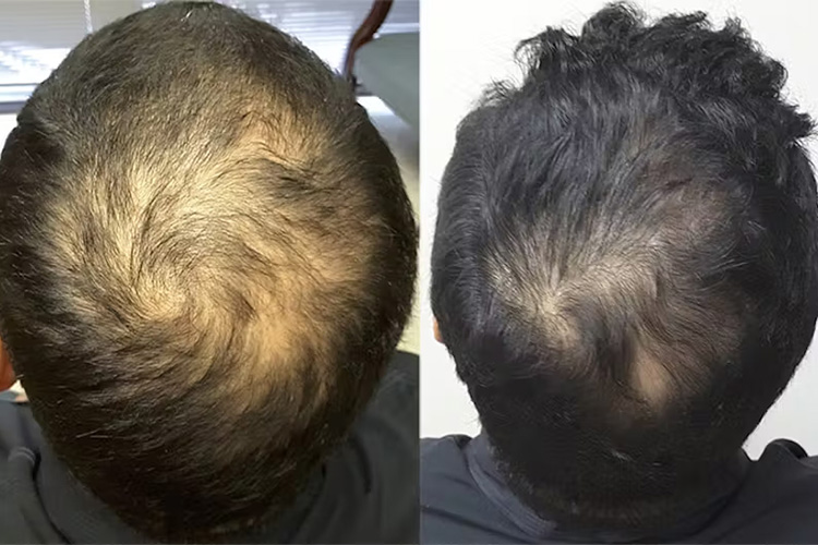 How Long Do Hair Growth Pills For Men Take to Work