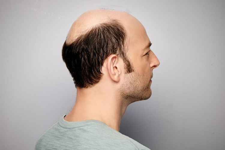 Male Hair Loss